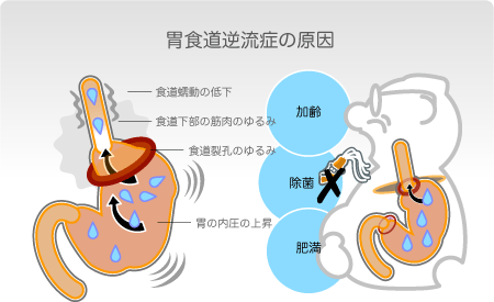 加齢、肥満に加え、ピロリ菌の除菌も胃食道逆流症の一因となる 逆流の原因