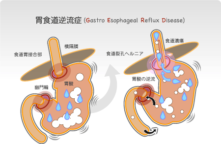 逆流性食道炎とは