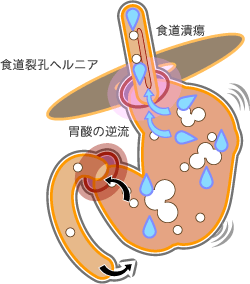 食道裂孔ヘルニアは胃酸の逆流、食道潰瘍の原因 逆流性食道炎のメカニズム