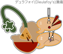 デュラフォイ(Dieulafoy's)潰瘍への内視鏡止血術 デュラフォイ(Dieulafoy's)潰瘍