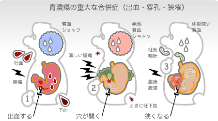 出血、穿孔、狭窄が胃潰瘍の手術適応 胃潰瘍の重大な合併症