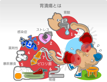 胃潰瘍はさまざまな原因でおきる 胃潰瘍の原因