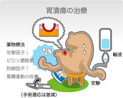 胃潰瘍治療には安静、輸液、さまざまな薬物療法 胃潰瘍の治療