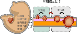 早期癌は粘膜下層までの深達 胃早期癌とは