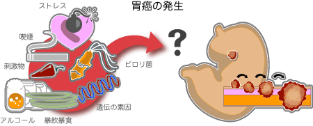 胃癌発生はさまざまな生活習慣が引き金に 胃癌発生の原因