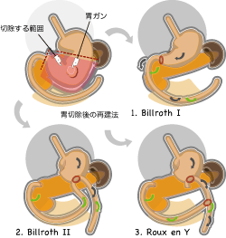 幽門側胃切除術とよくある再建方法 幽門側胃切除術