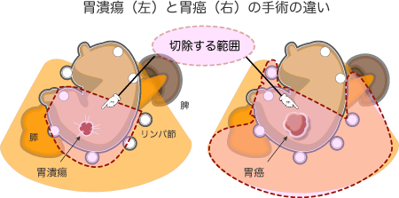 胃癌ではリンパ節を含め切除 胃潰瘍と胃癌の手術の違い