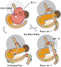 胃全摘術(膵尾、脾合併切除)とよくある再建方法 胃全摘術