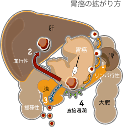 胃ガンの拡がり方は血行性、リンパ行性、播種性、直接浸潤 胃癌の進行様式