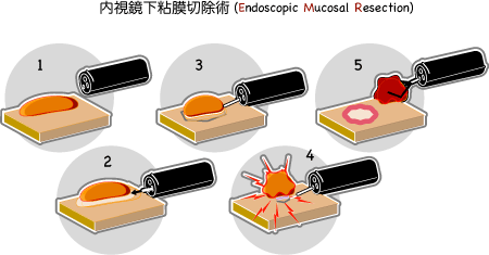 内視鏡下粘膜切除術