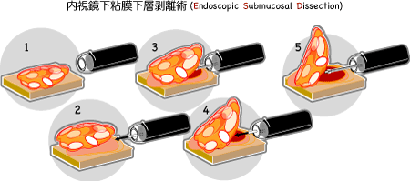 内視鏡下粘膜下層剥離術