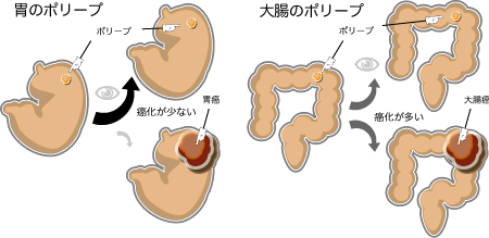 胃の良性ポリープは、大腸と違い癌化しにくい。 胃と大腸の良性ポリープの違い