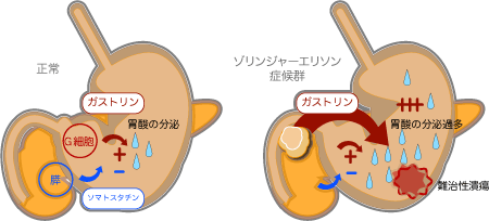 ガストリノーマによるガストリン過分泌が難治性潰瘍の原因 ゾリンジャーエリソン(Zollinger Ellison)症候群