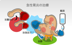 急性胃炎はまず安静、輸液と投薬を 急性胃炎の治療