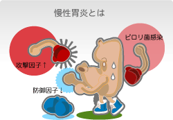 慢性胃炎発症には防御因子の低下、ピロリ菌感染が重要 慢性胃炎の原因