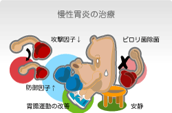 治療にはピロリ除菌をふくめ投薬が必要 慢性胃炎の治療