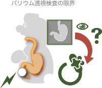 バリウム検査の問題点