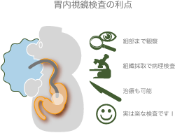 細部の観察だけでなく、病理検査、治療も可能 胃内視鏡検査の利点