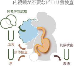 尿素呼気試験、抗体検査、抗原検査は内視鏡不要 内視鏡を要さないピロリ菌検査