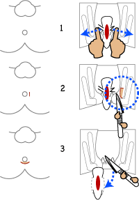 裂肛の治療法について